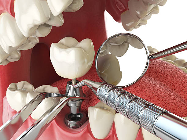 Best Emergency Dental Care for Broken or Chipped Teeth in Dumbarton, VA